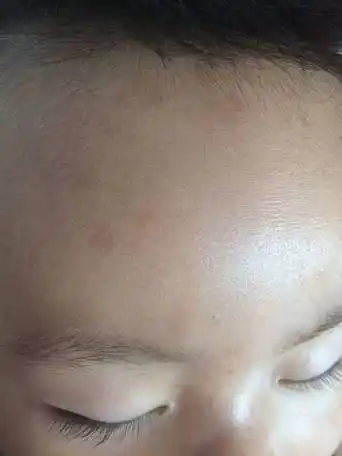 宝宝额头的斑点