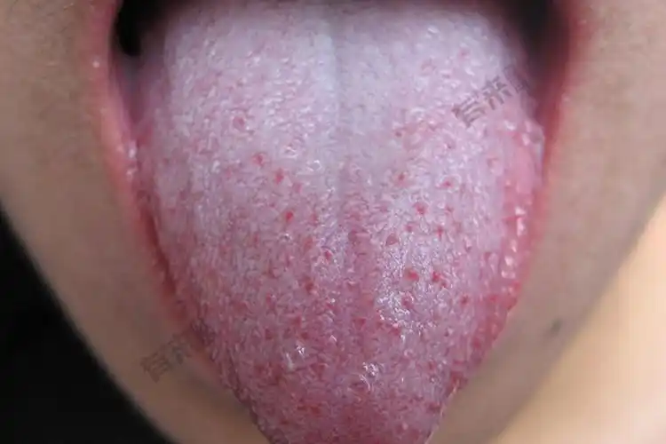 草莓舌,杨梅舌:在疾病的初期患者舌头上有白苔,红肿的乳头凸出于白苔