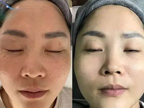 雀斑和晒斑比较多特别是颧骨这个地方尤其明显