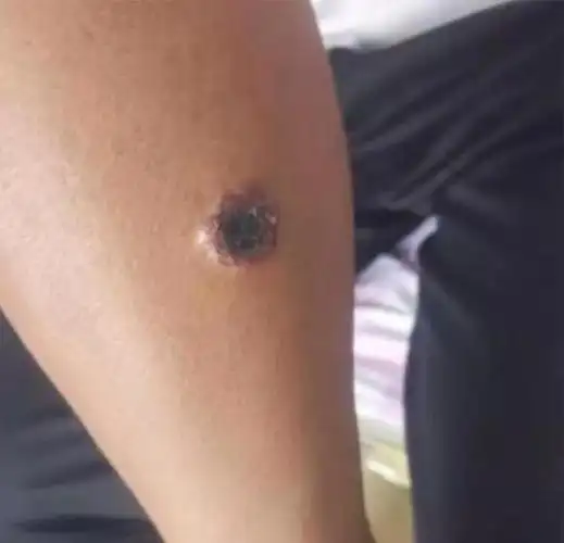 (滑动查看病例图片/图源:中国疾控中心)肠炭疽可表现为急性肠炎型或