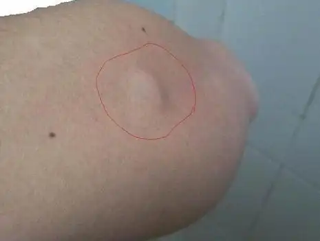 皮下脂肪瘤图片46