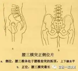 [教学查房]教学相长之走进腰三横突综合征!