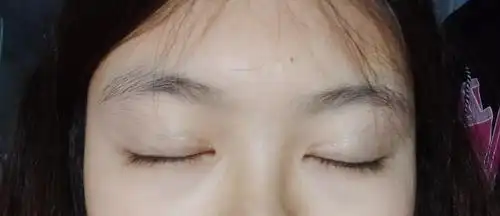 原来内双巨肿眼泡,晚上拍的可能要比白天消肿一点