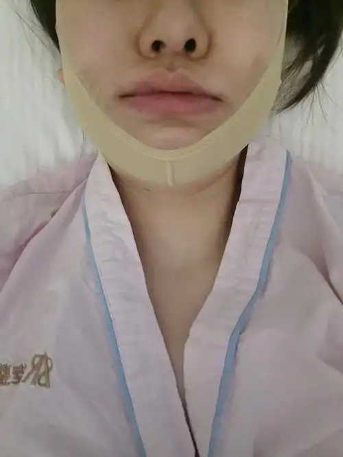 咬肌切除术后当天