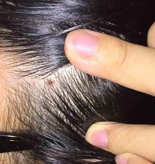 头皮棕色斑块请各位老师诊断是什么