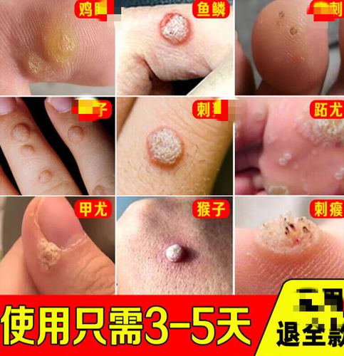 来和悦康疣灵腋下侯子皮赘肉粒疙瘩脚手上刺猴休子点疙瘩颈部寻常刺猴