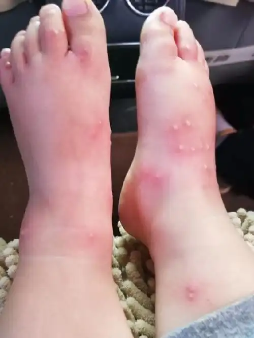 红蚂蚁咬人后症状图片(教你几种有效的治疗方法)