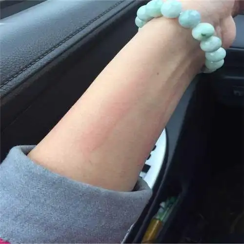 胆碱能性荨麻疹女生图片