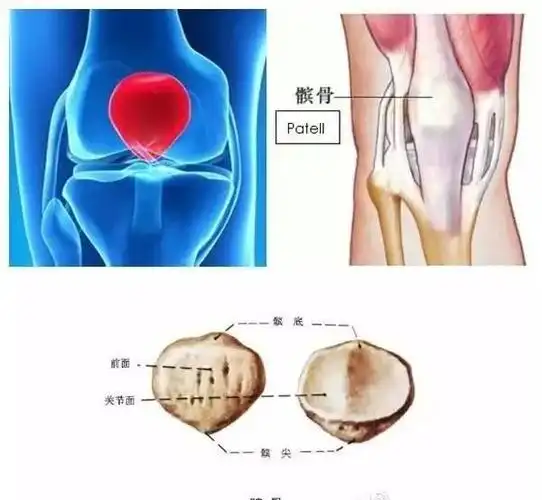 白色部分为髌骨的软骨,发黄的部分是软骨剥脱区域)如果把膝关节腔比作