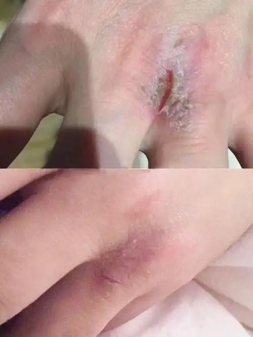 (手足皲裂华肤治疗3天效果)