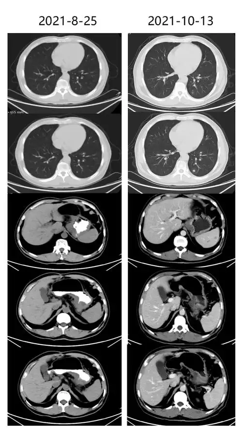 百启新生未来可期逆转化疗耐药替雷利珠单抗治疗晚期胃癌病理完全缓解