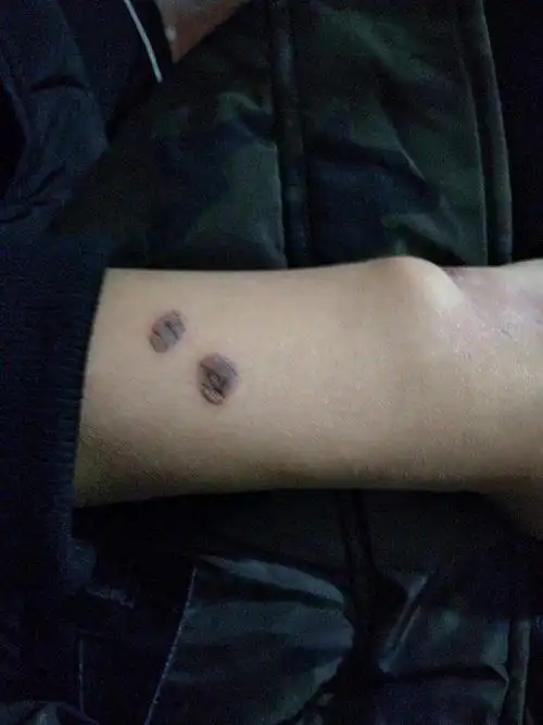 我用烟头烫自己手臂,烫了隔天起了水泡,黑色的,烫了2个,事后很后悔,我