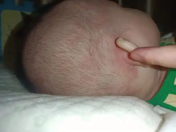 我家宝宝刚100天了,头上湿疹已经反反复复20多天,宝宝特别的痒,痒的头