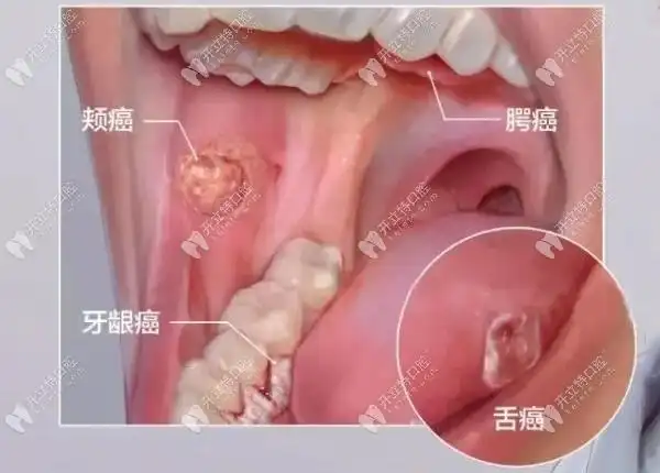 牙龈癌的早期症状和图片以及引起牙龈癌的原因都在这里