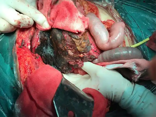 我院成功完成一例外伤性肝破裂第七段切除术 - 美篇