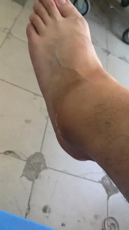 脚崴了,肿了,有么办法缓解疼痛啊