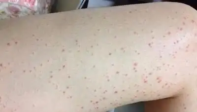 初期会有什么症状?紫癜的早期症状图片