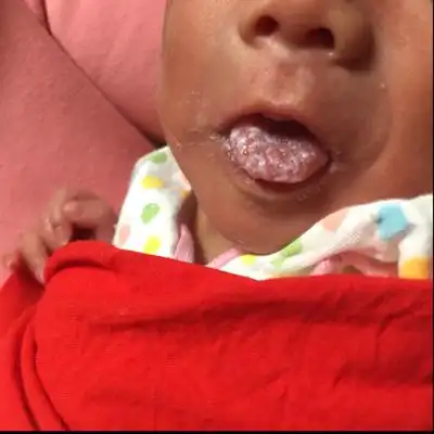 宝宝舌头全是这个,不知道什麼东西!该如何治疗