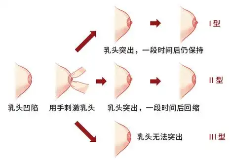 乳头凹陷怎么喂奶?2种牵拉方法很好用