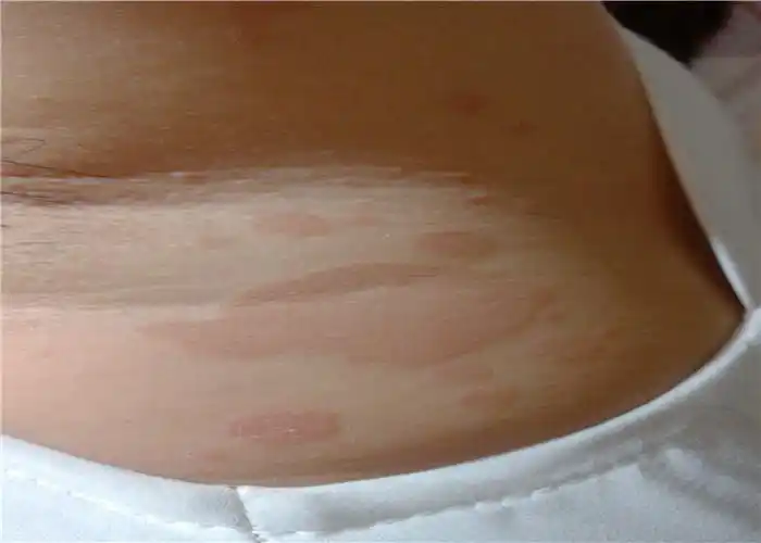 花斑癣初期图片_有来医生