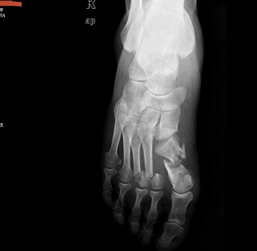 右足多发性跖骨骨折伴跗跖关节脱位以及骨筋膜室综合征的治疗 - 病例