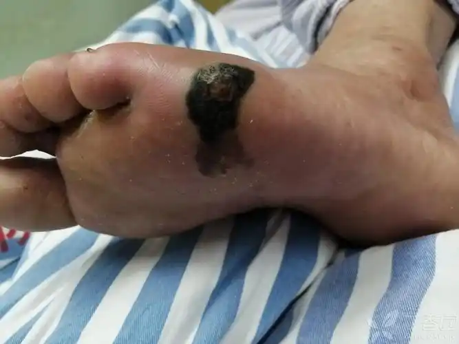 色素痣和恶性黑色素瘤鉴别一下