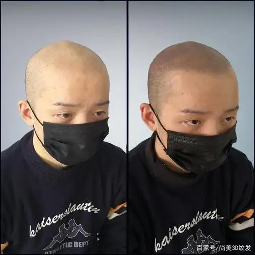 头发纹上去,十年秃顶纹发的重生之路