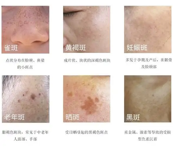 色斑|祛斑|美白|祛斑产品_网易订阅