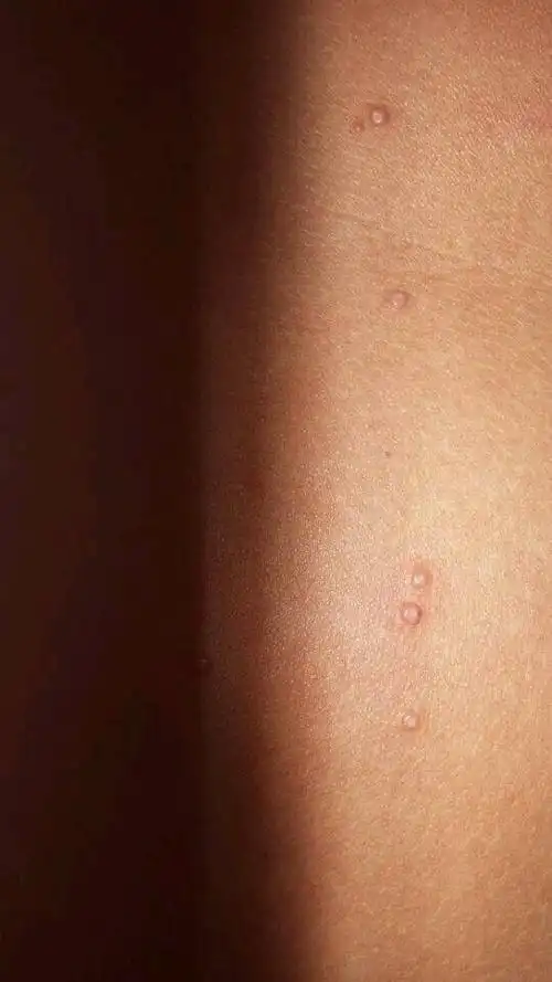 这是什么,在后背上,不痛,不痒