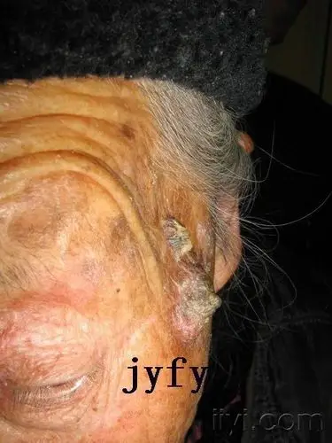 辞旧迎新2-高分化鳞癌所致皮角 - 皮肤及性传播疾病讨论版 - 爱爱医