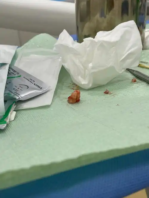 拔智齿分享1,有血液系统疾病者不建议拔智齿,可能会因拔智齿出血