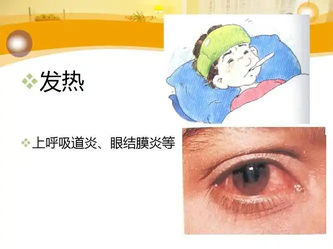 发热   上呼吸道炎,眼结膜炎等