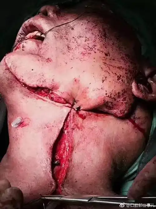 "槟榔"成口腔癌高发主要诱因!槟榔加烟,法力无边