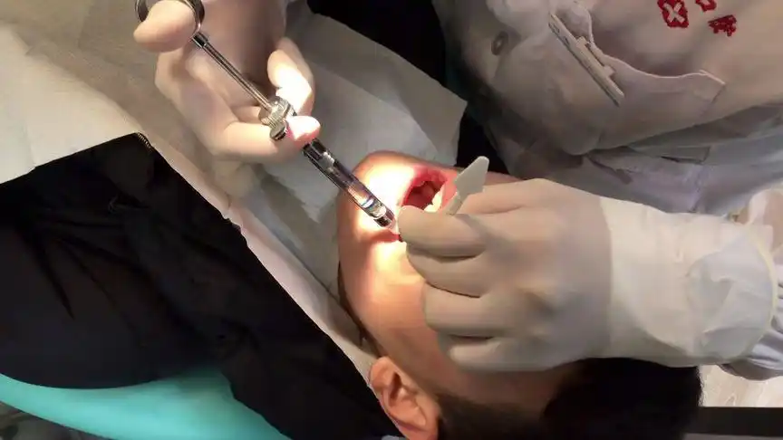 儿子矫正牙齿,今天第二次拔牙,医生拿的注射器太吓人了