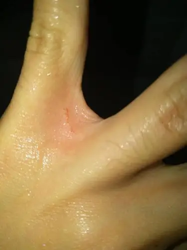 刚刚跟狗玩被抓破一点,又事么,谁帮我看下.