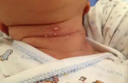 医学被称为新生儿脓疱疹,此病主要是好发生在新生儿