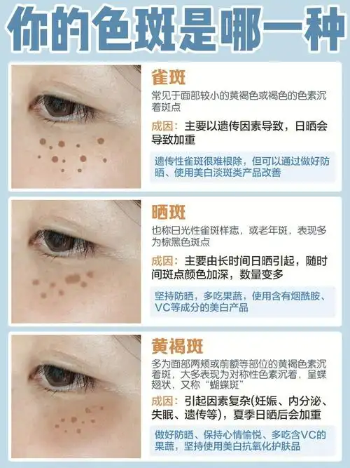 黄褐斑通常出现在面部,特别是颧骨区域