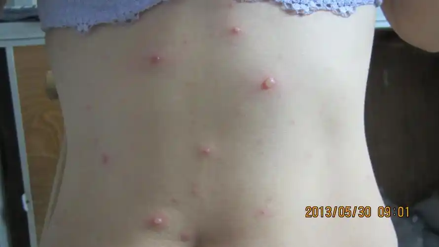 不够典型,追问病史得知患者所带教的班级中前几周陆陆续续有水痘患儿