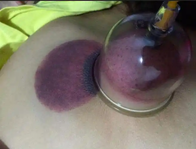 拔火罐后背吸出来的瘀血,是身体内的毒素吗?不妨听听专家怎么说