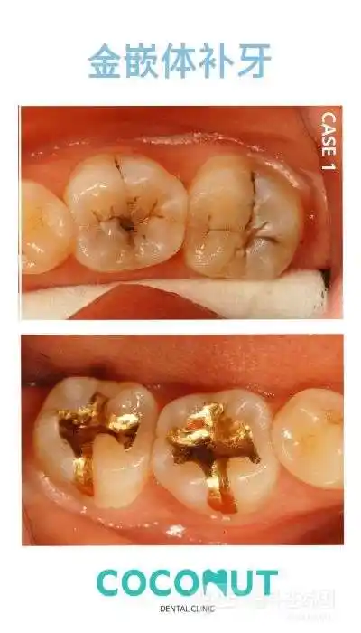 补牙也有大学问!