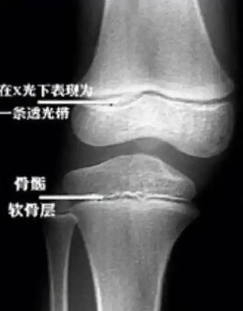 骨骺线未闭合