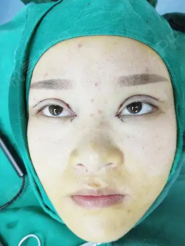 眼综合手术当天_双眼皮手术当天_眼部整形手术当天_悦mer_7795512117