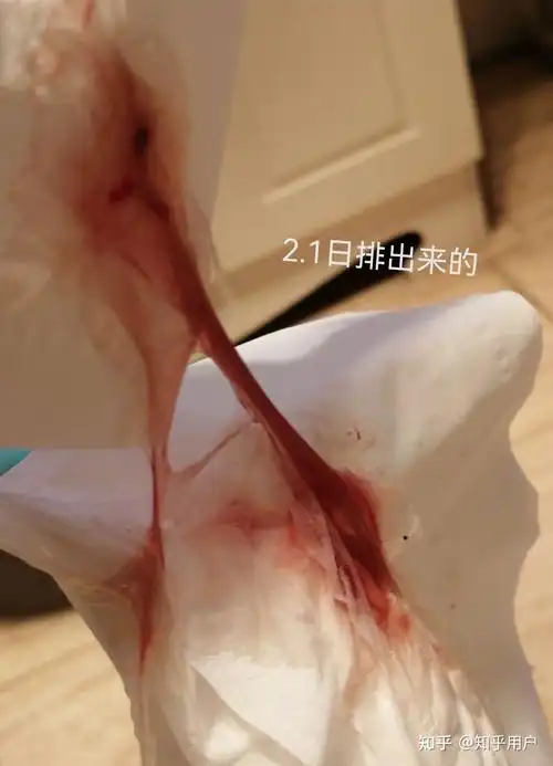 药流后有3.5cm残留,保守治疗近80天,清楚残留