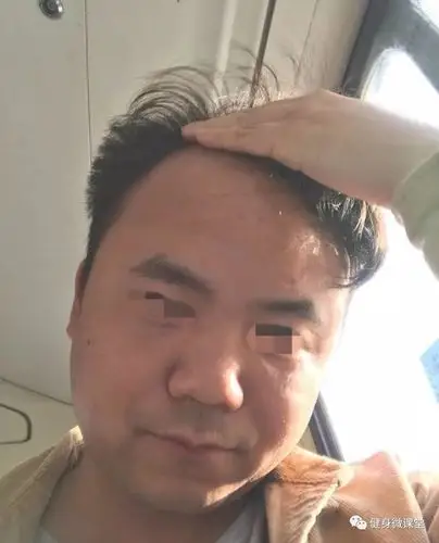 网友晒四年前后对比照看熬夜后的惨痛后果