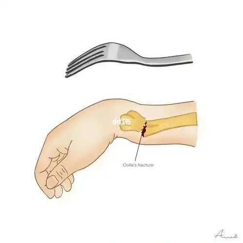 colles骨折