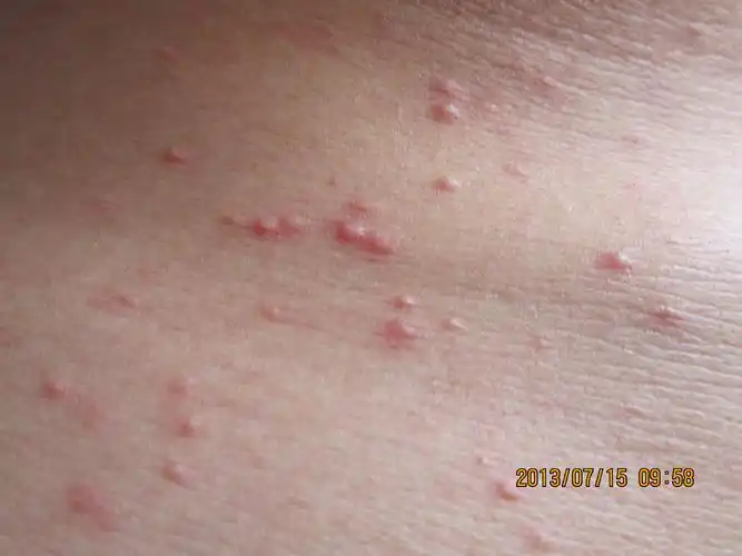 糠皮孢子菌毛囊炎? - 皮肤及性传播疾病讨论版 - 爱爱医医学论坛