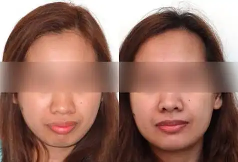 原来牙齿矫正真的可以改变脸型