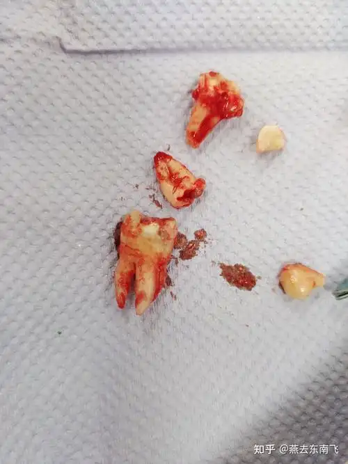 初拔智齿 - 知乎