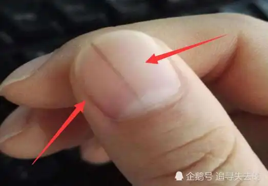 不论男女,指甲若冒出"竖纹线",多是"3顽疾"在捣鬼,趁早查