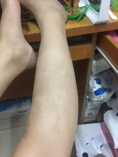 本人女,现在22岁,右小腿上长了很多花斑(左腿正常)从很小就有了,不